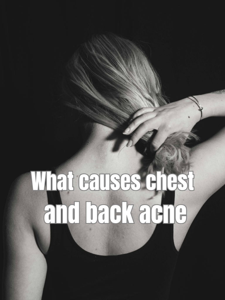 What causes chest and back acne